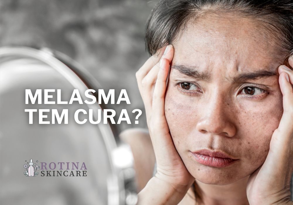 Melasma Tem Cura