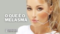 O Que é o Melasma Entenda Essa Condição de Pele Que Afeta Milhões de Pessoas