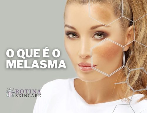 O Que é o Melasma? Entenda Essa Condição de Pele Que Afeta Milhões de Pessoas