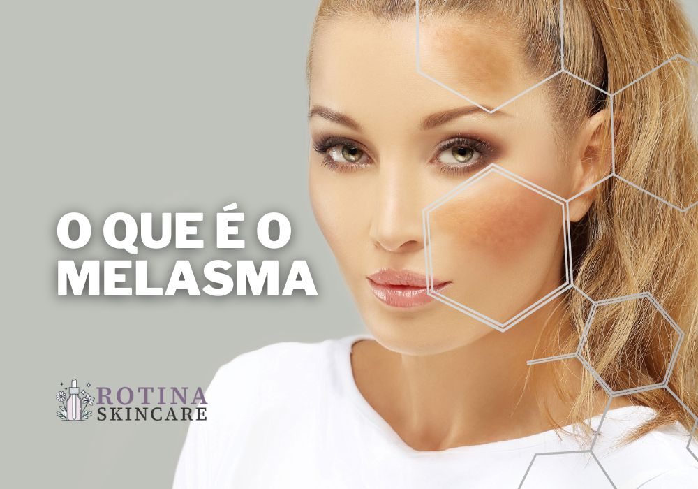 O Que é o Melasma Entenda Essa Condição de Pele Que Afeta Milhões de Pessoas