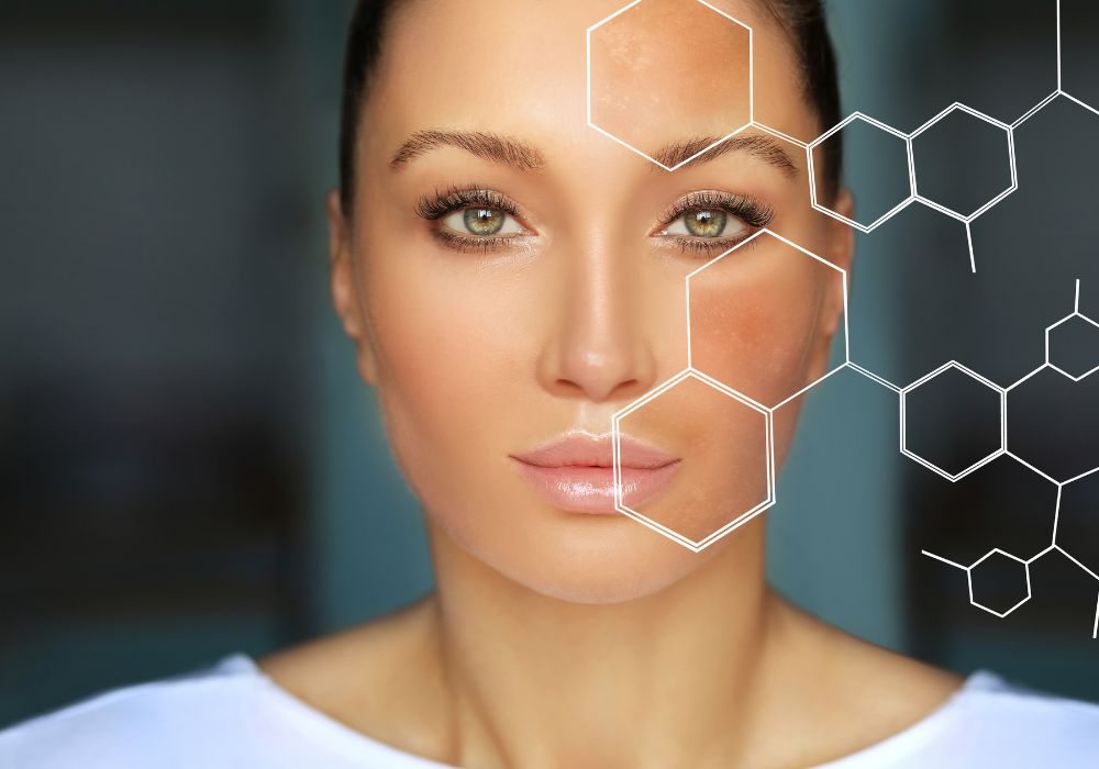 Quanto Custa um Tratamento Completo de Melasma