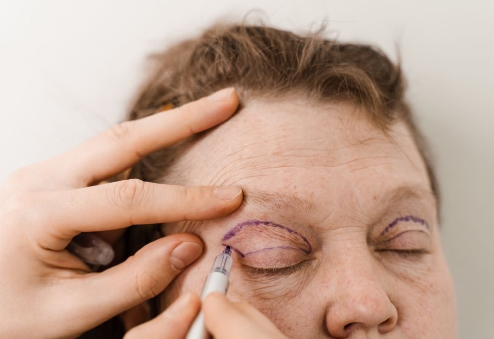 Quanto custa uma blefaroplastia
