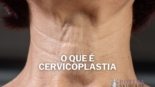 O que é Cervicoplastia de Rejuvenescimento do Pescoço Quanto Custa