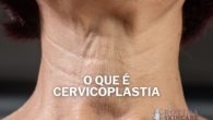 O que é Cervicoplastia de Rejuvenescimento do Pescoço Quanto Custa