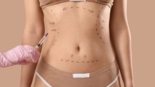 Quanto Custa a Abdominoplastia O que é e Como Funciona