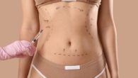Quanto Custa a Abdominoplastia O que é e Como Funciona