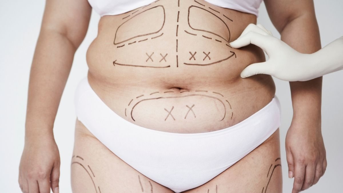 Quanto Custa a Lipoaspiração e Como Remove a Gordura Localizada