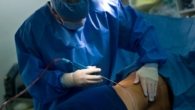 Quanto custa uma lipoaspiração