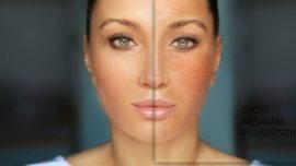 Melhor Peeling para Manchas no Rosto Mais Eficaz Para a Sua Pele