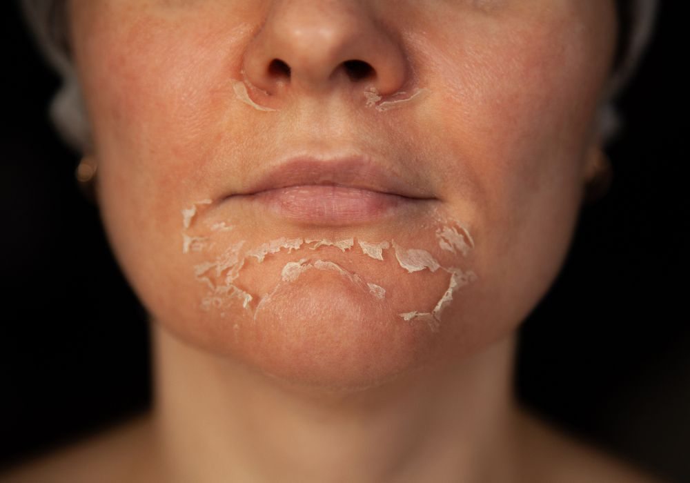 Quais são os melhores tipos de peeling para manchas no rosto
