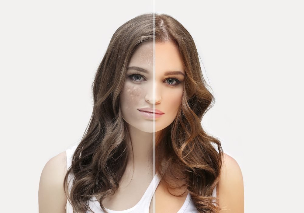 Qual o Melhor Sérum para Tratar Melasma