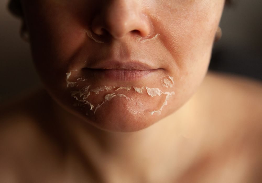 Quanto custa o Peeling Inteligente com Ação Controlada em 2025