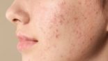 Ácido Salicílico no Tratamento da Acne Ativo Mais Recomendado