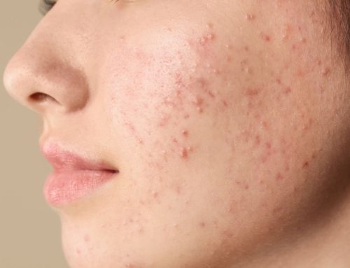 Ácido Salicílico no Tratamento da Acne: Ativo Mais Recomendado