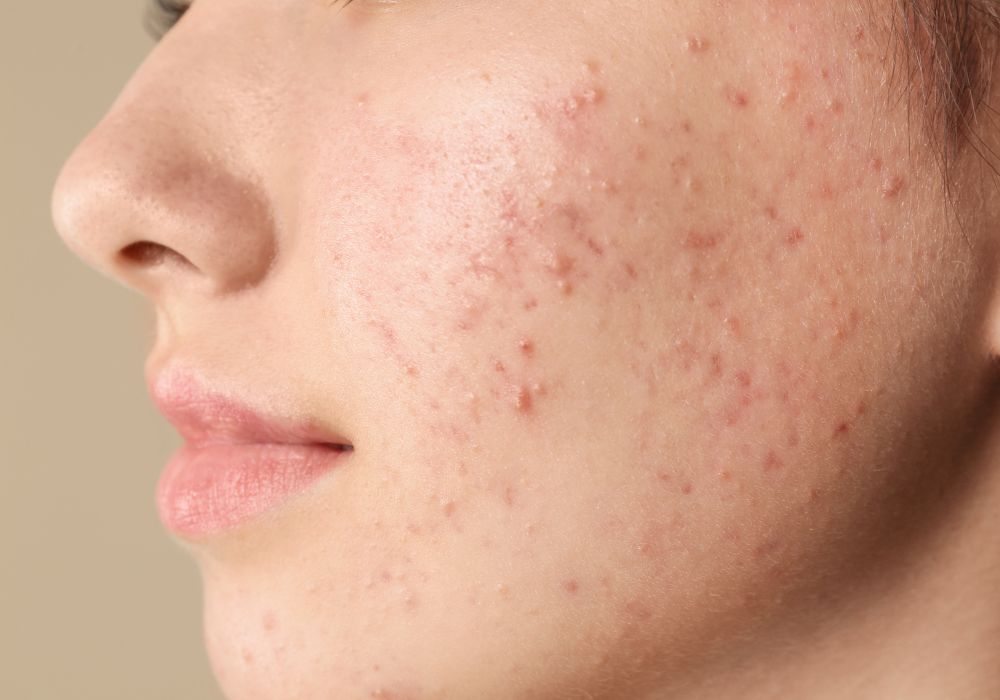 Ácido Salicílico no Tratamento da Acne Ativo Mais Recomendado