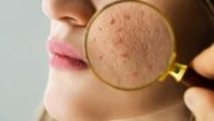 Melhores Produtos para Quem Tem Pele com Acne