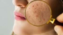 Melhores Produtos para Quem Tem Pele com Acne