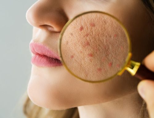Melhores Produtos para Quem Tem Pele com Acne