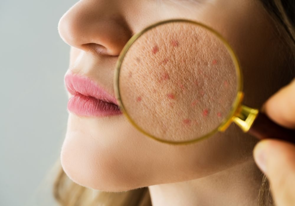 Melhores Produtos para Quem Tem Pele com Acne