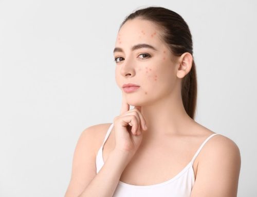 Quais Ácidos São Indicados para Tratar Acne? Melhores e Como Usá-los
