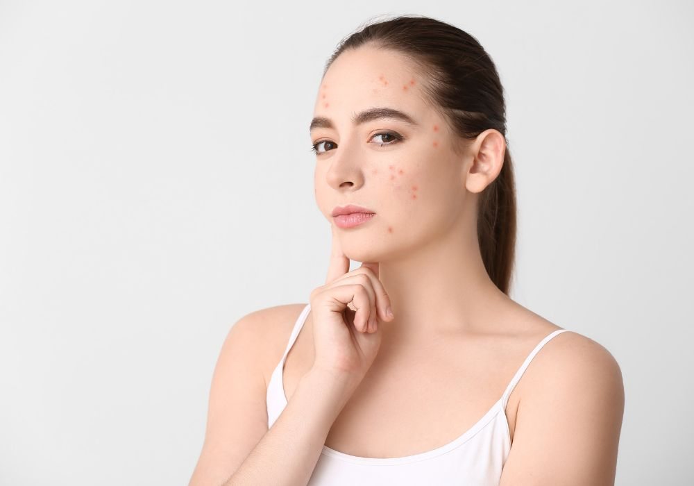 Quais Ácidos São Indicados para Tratar Acne Melhores e Como Usá-los