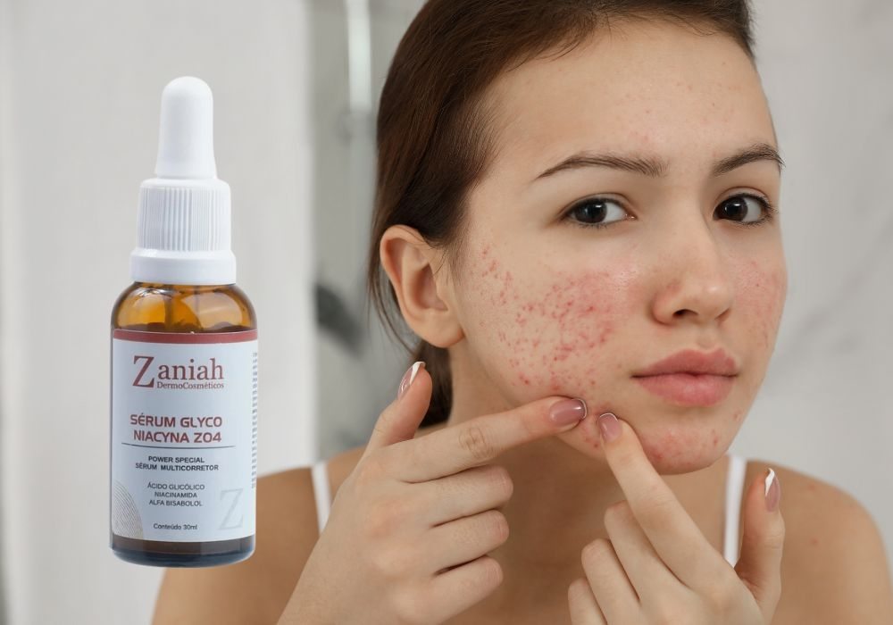 Zaniah Glyco Niacina Anti-Acne – Uma combinação poderosa para tratar acne