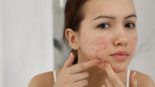O que é Alfa Bisabolol e como ele Ajuda no Tratamento de Acne e Oleosidade