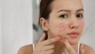 O que é Alfa Bisabolol e como ele Ajuda no Tratamento de Acne e Oleosidade