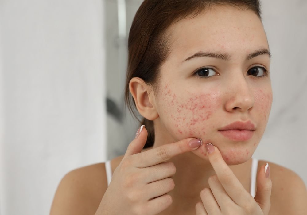 O que é Alfa Bisabolol e como ele Ajuda no Tratamento de Acne e Oleosidade