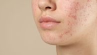 Rotina de Skincare para Peles Oleosas e Acneicas Dicas e Produtos Essenciais