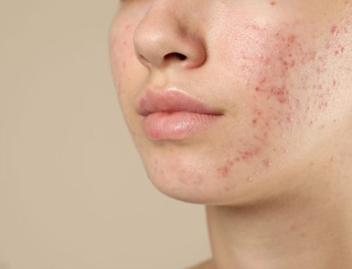 Rotina de Skincare para Peles Oleosas e Acneicas: Dicas e Produtos Essenciais