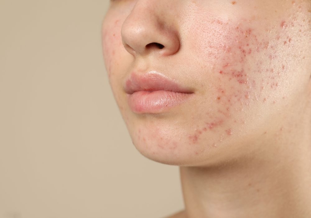 Rotina de Skincare para Peles Oleosas e Acneicas Dicas e Produtos Essenciais