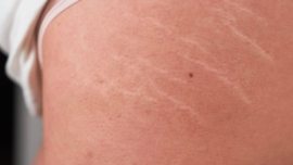 Melhor Tratamento para Estrias Brancas e Vermelhas e Média de Preço