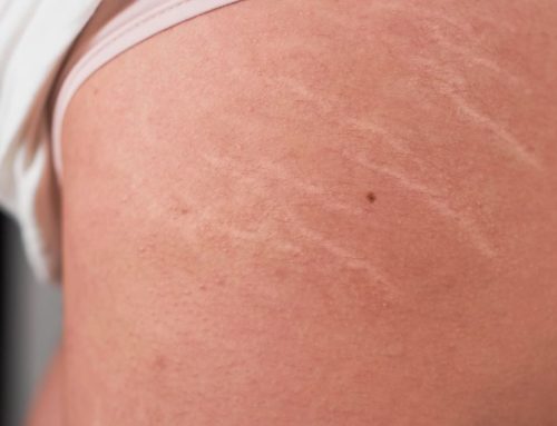 Melhor Tratamento para Estrias Brancas e Vermelhas e Média de Preço