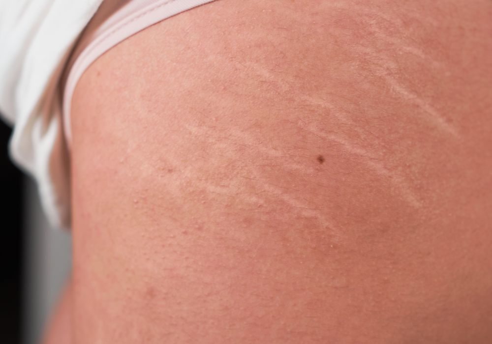 Melhor Tratamento para Estrias Brancas e Vermelhas e Média de Preço
