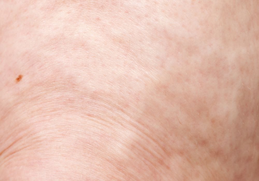 produtos eficazes para tratar celulite (e o preço médio) produtos eficazes para tratar celulite (e o preço médio)