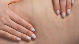 Qual o Melhor Tratamento para Celulite e Como Escolher