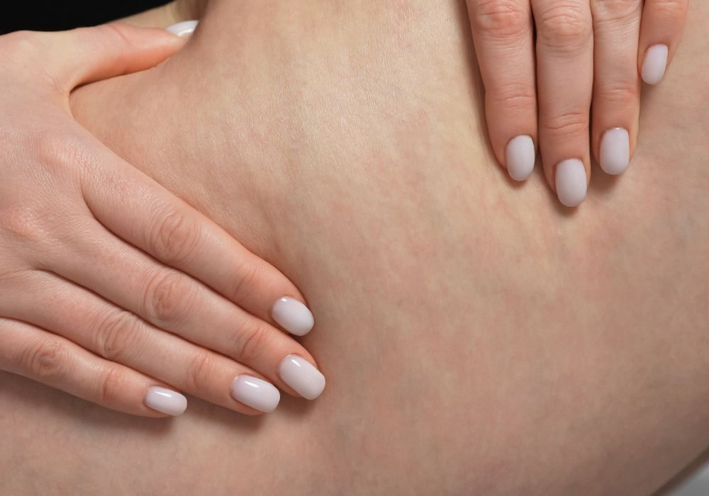 Qual o Melhor Tratamento para Celulite e Como Escolher Qual o Melhor Tratamento para Celulite e Como Escolher